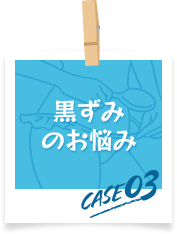 黒ずみのお悩み　case03